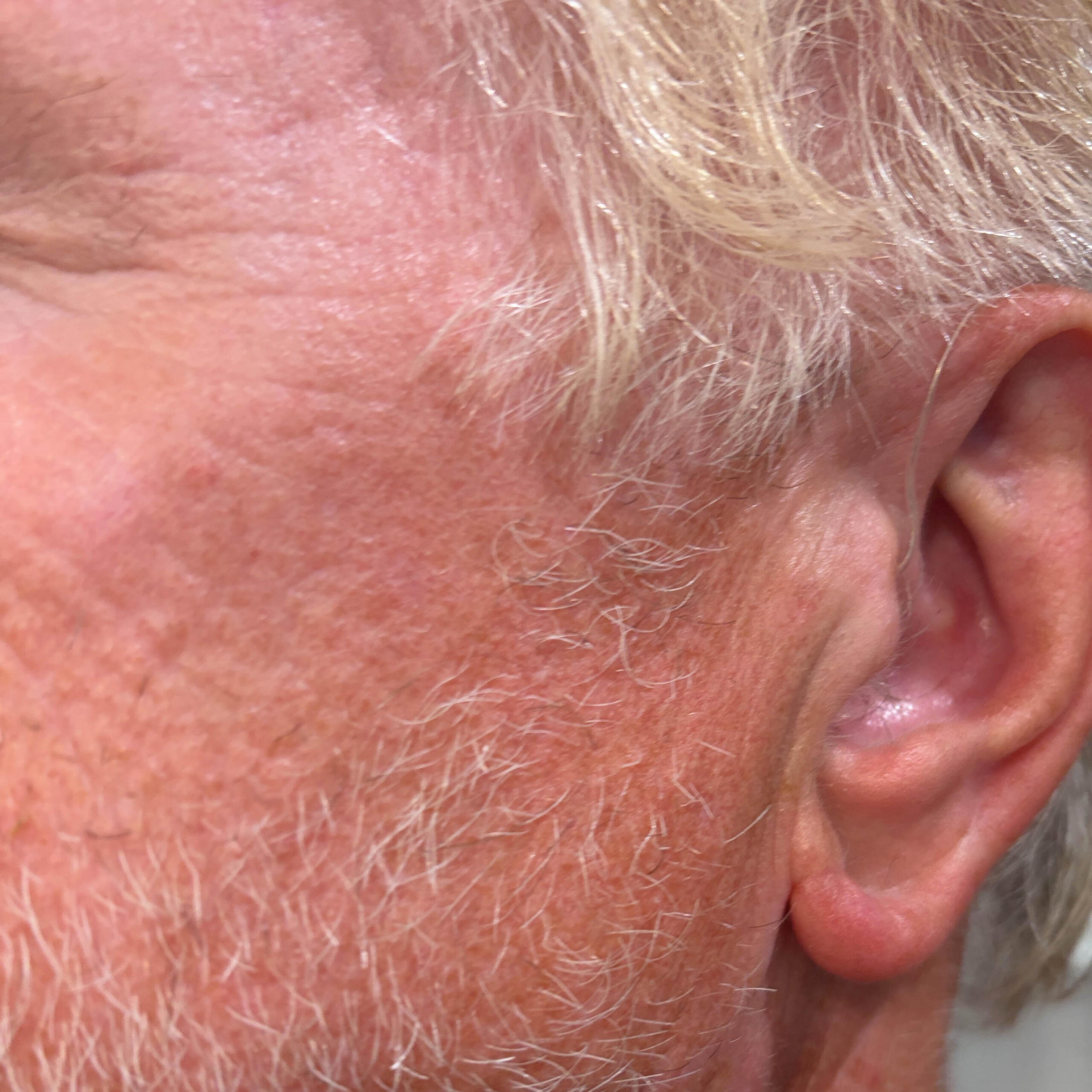 Left Cheek after case 414