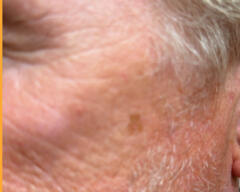 Left Cheek before case 414
