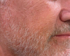 Right Cheek after case 413