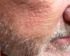 Right Cheek before case 413
