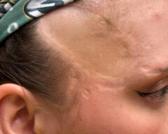 after photo forehead case 412