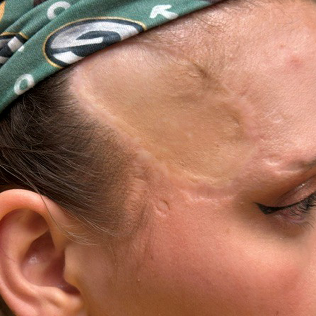 after photo forehead case 412