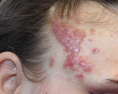 before photo of forehead case 412