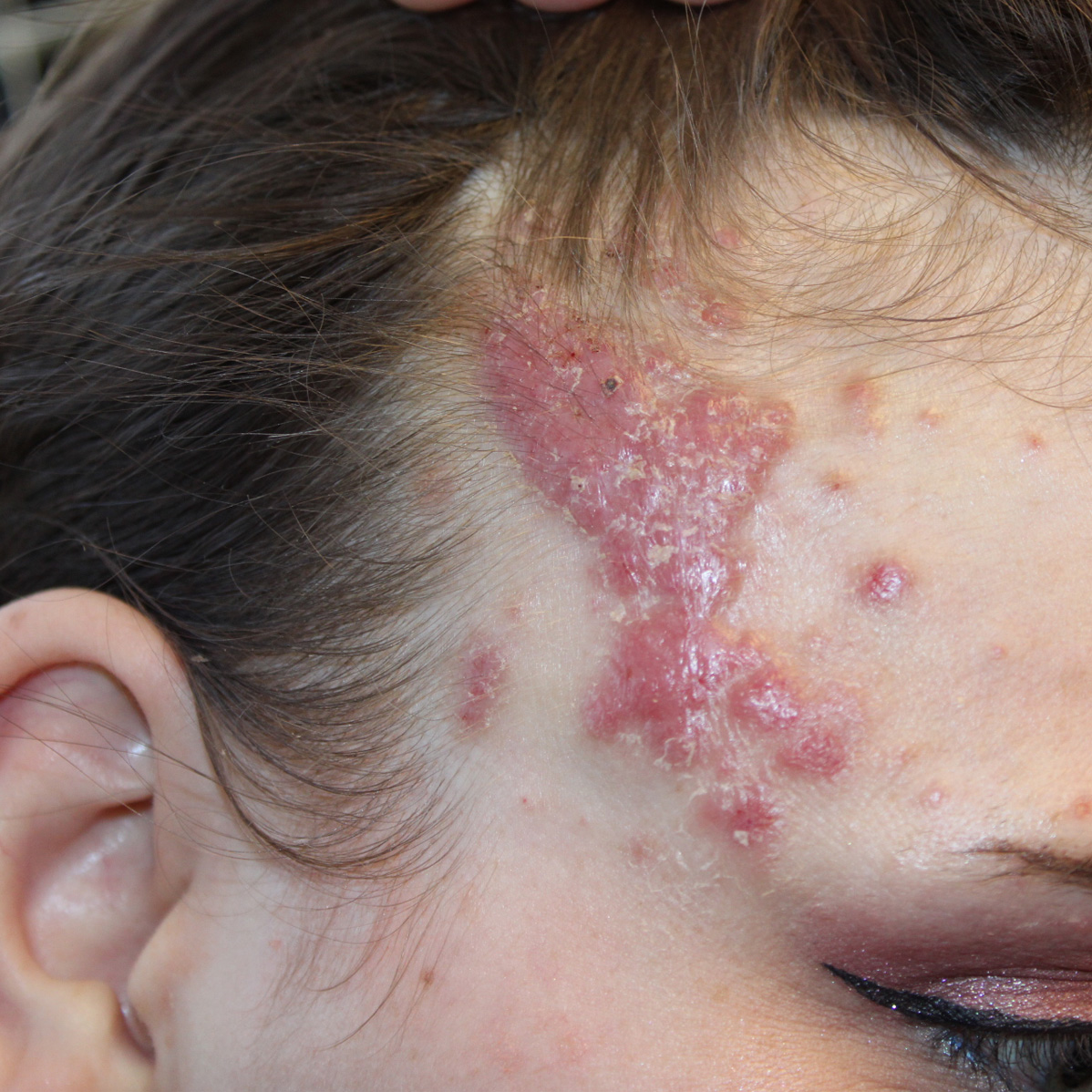 before photo of forehead case 412