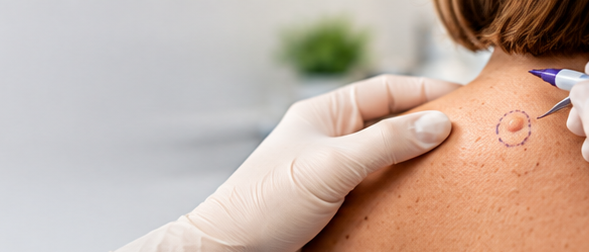 cyst removal banner
