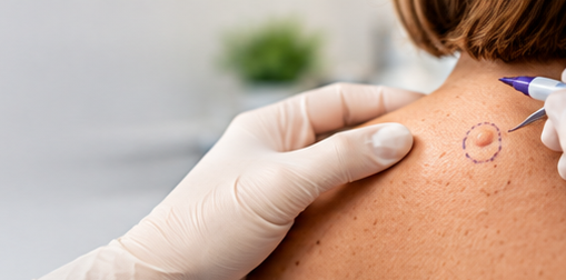 cyst removal banner